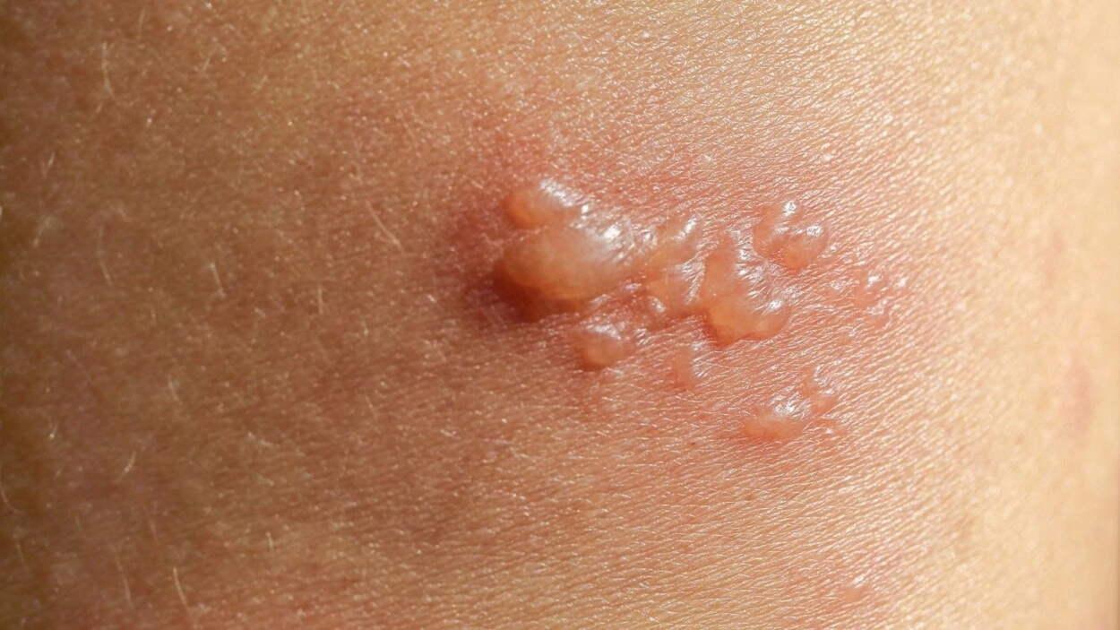 Waspada cacar api atau Herpes Zoster menjadi langkah penting bagi orang dewasa untuk tetap sehat, aktif, dan produktif seiring bertambahnya usia. (Ilustrasi/TRENDS.co.id)